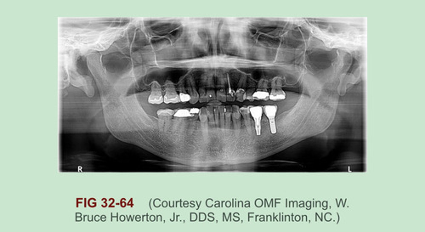 <p>- All Porcelain crown (#2 & #3)</p><p>- PFM (Porcelain fused to metal)</p><p>- Dental implant (#19 & #18)</p><p>- Amalgam</p><p>- Gold foil Filling</p><p>- Gutta percha (#10)</p>