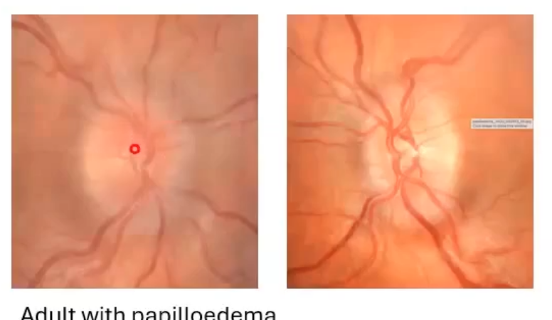 <p>more papilloedema </p>