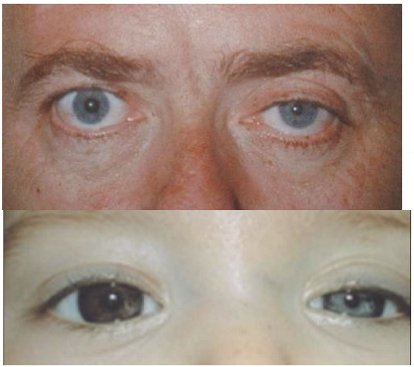 <ul><li><p>Miosis</p></li><li><p>Ptosis</p></li><li><p>Anhidrosis</p></li><li><p>Heterochromia irides</p></li></ul><p></p>