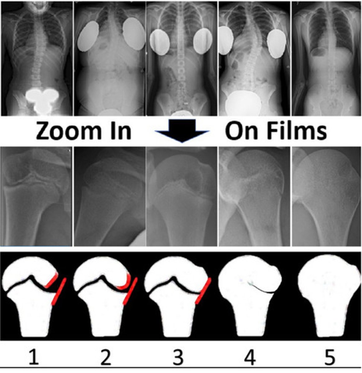 <p>1. Risser sign</p><p>2. Triradiate cartilage</p><p>3. Sanders scale (hand)</p><p>less common options include:</p><p>-ossification of rib heads</p><p>-cervical spine appearance</p><p>-knee</p><p>-foot</p><p>-calcaneal apophysis</p><p>-elbow</p><p>-proximal humeral epiphysis</p>