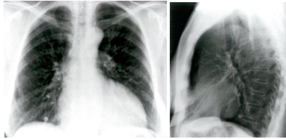 <p>Changes in cardiac silhouette</p><ul><li><p>Cardiomegaly</p></li><li><p>Pericardial effusion</p></li></ul><p>Pulmonary congestion</p><p>Valve calcification</p>
