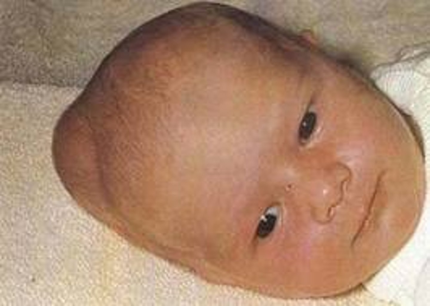 <p>A collection of blood that pools between a newborn's skull bone and its outer covering.</p>