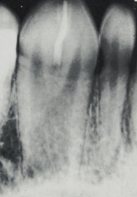 <p>what dental abnormality is shown here? </p>
