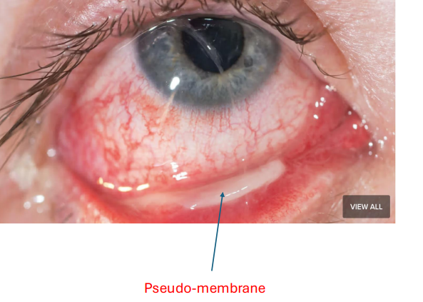 <ol><li><p><strong><u>• Mucopurulent discharge </u></strong></p></li><li><p><strong><u>• Conjunctival papillae </u></strong></p></li><li><p>• Conjunctival hyperemia </p></li><li><p>• Chemosis </p></li><li><p>• Foreign body sensation</p></li><li><p> • Lid Edema •</p></li><li><p><strong><mark data-color="yellow" style="background-color: yellow; color: inherit"><u> Pseudo-membranes</u></mark></strong></p><p></p></li></ol><p></p>