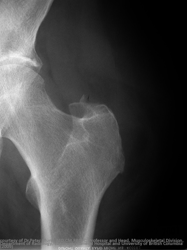 <p>Rest for 4–6 weeks.</p>