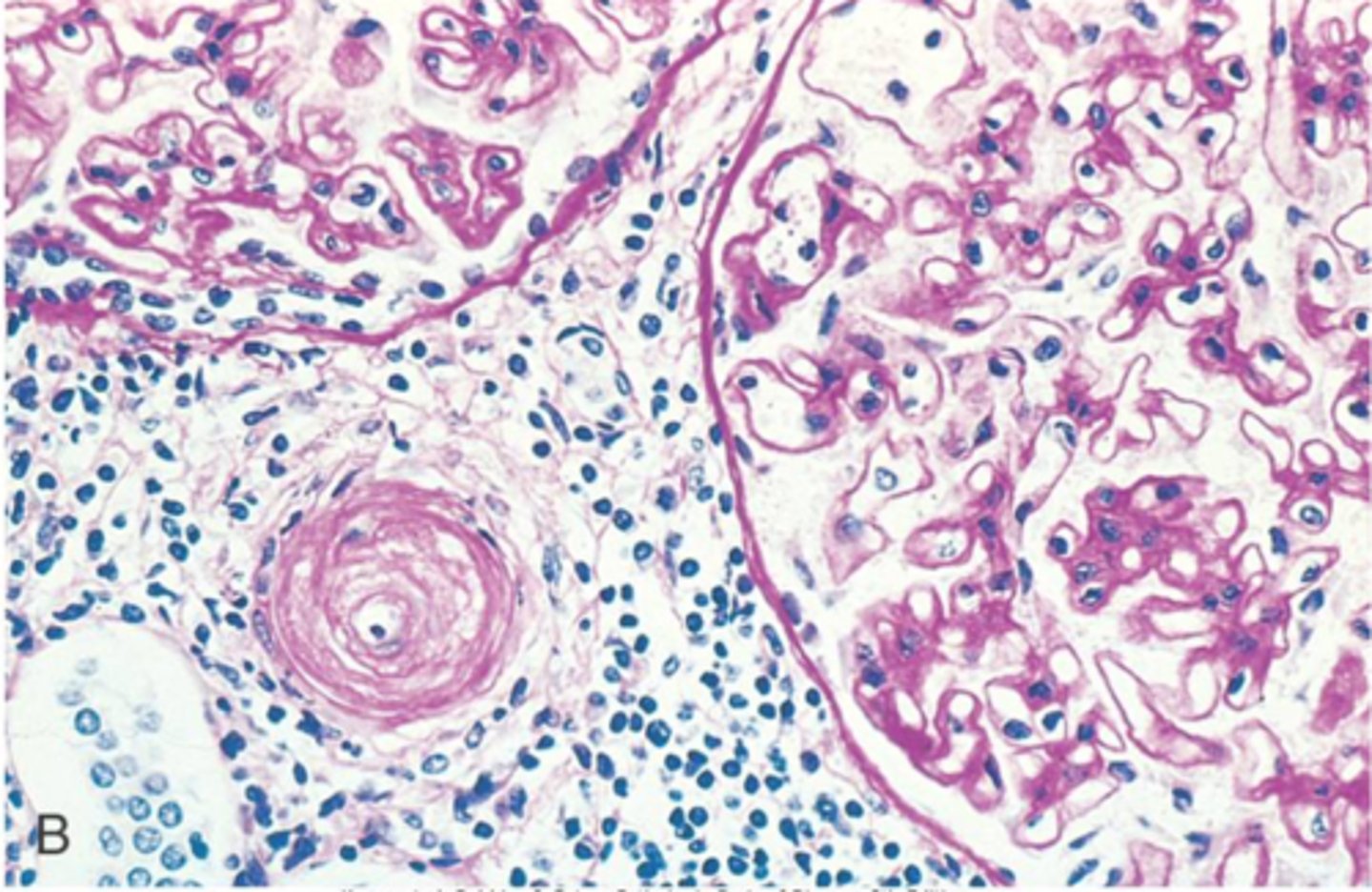 <p>inflammation of an arteriole</p>