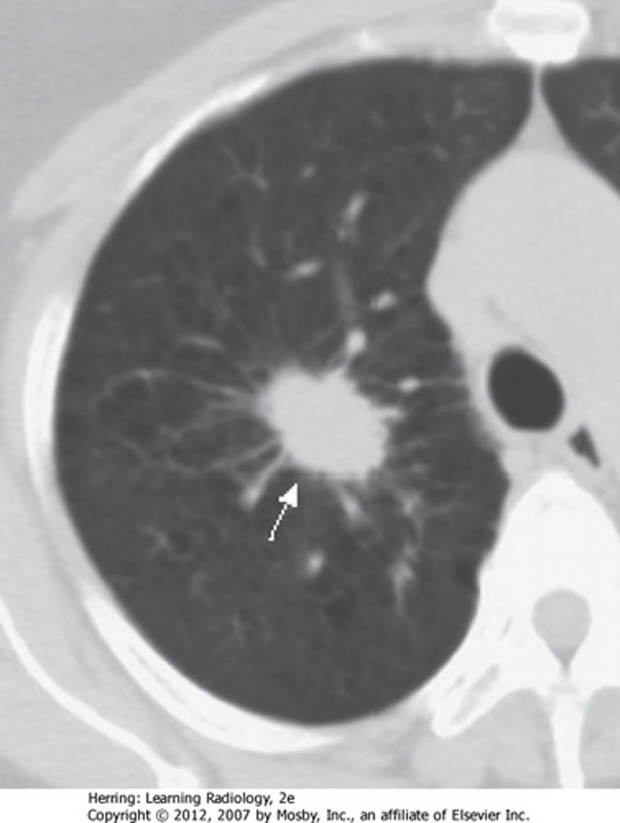 <p>cancerous tumor originating in a bronchus (also referred to as lung cancer)</p>