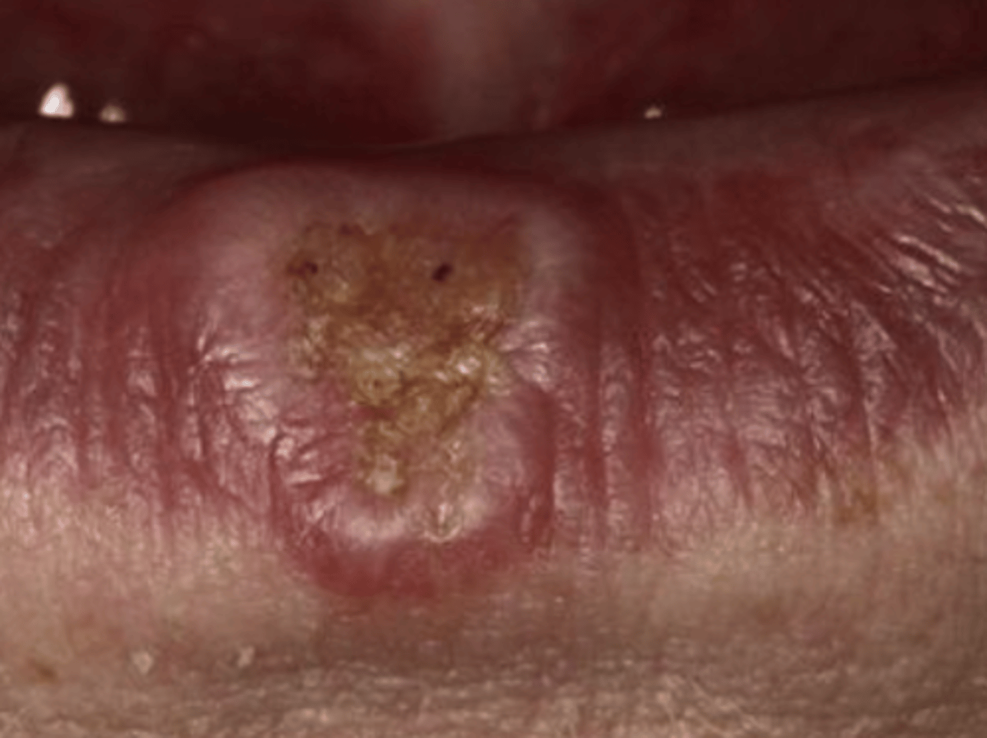 <p>Chronic UV radiation</p><p>70% have outdoor jobs</p><p>**Usually associated with Actinic Cheilosis</p><p>90% on the lower lip</p>