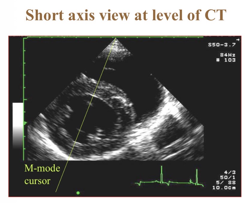 <p>Chordae tendinae </p>