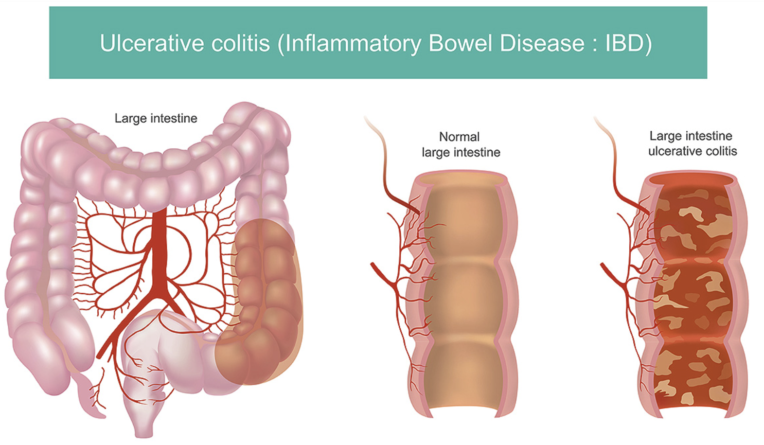 <p><span>IBD that primarily affects colon, causing inflammation and ulcers in the lining of these organs</span></p>