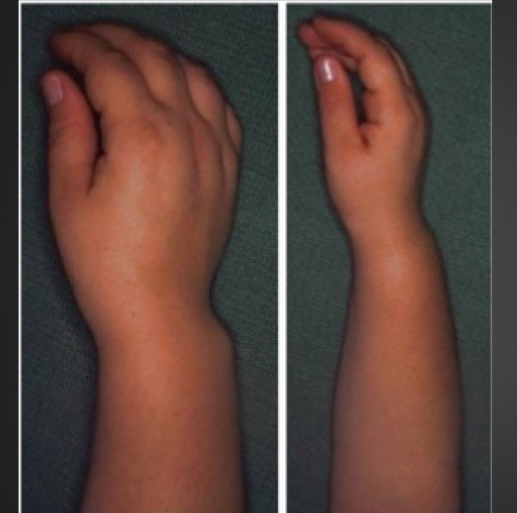 <p>this physical appearance is characteristic of what?</p>