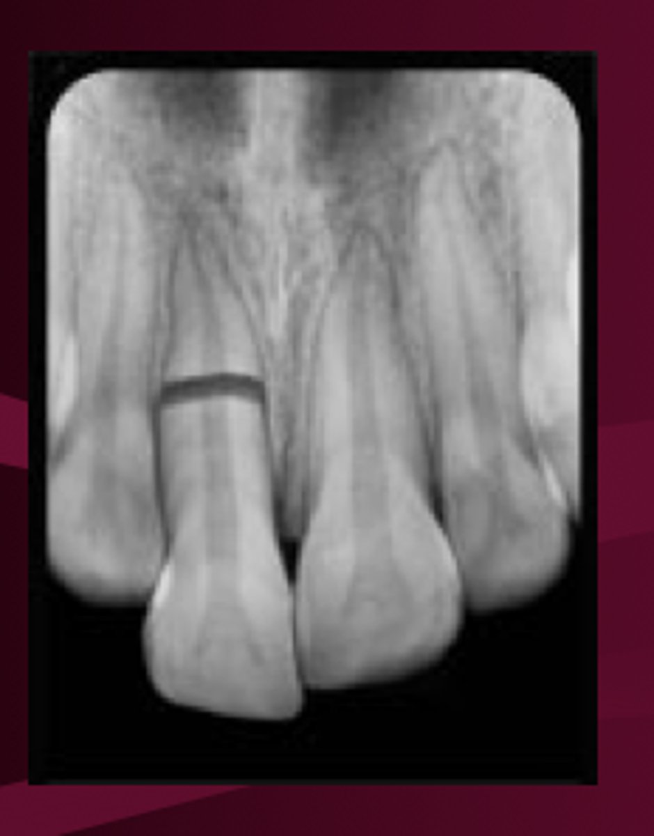 <p>coronal fragment may be mobile and may be displaced</p><p>occlusal interference may be present</p>