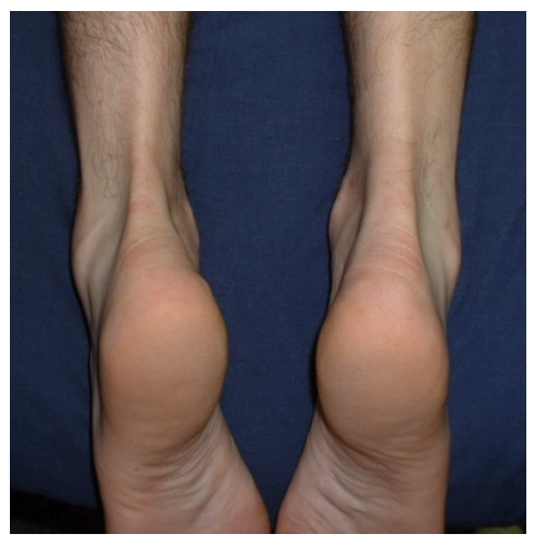 <p>Achilles Tendinopathy</p>