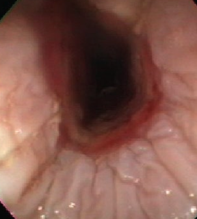 <p>with endoscopy</p>