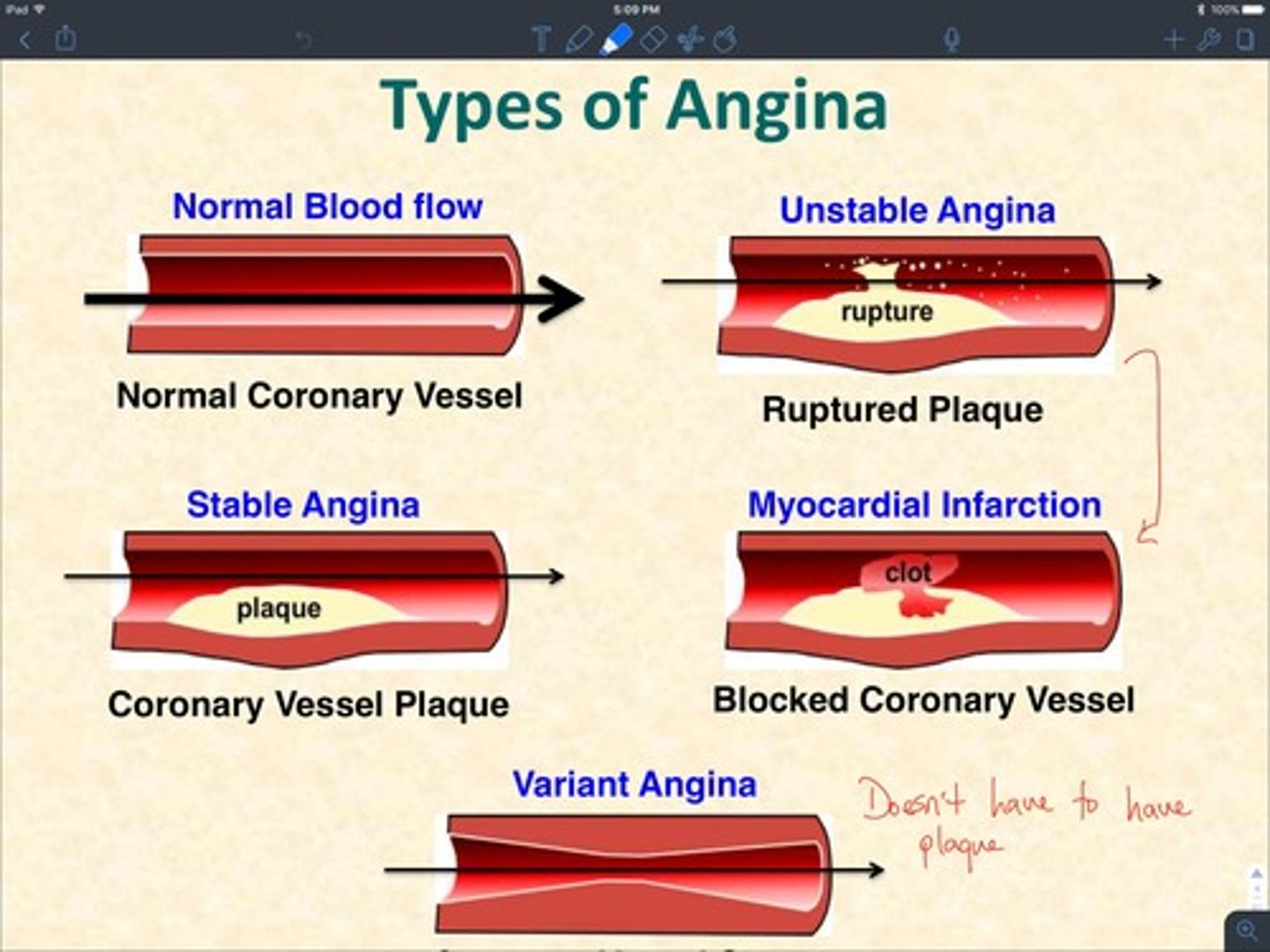 <p>frequency and severity of attacks increase over time</p>