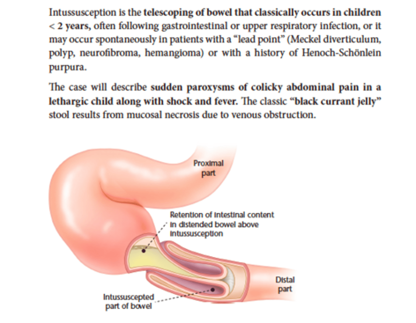<p>Air or contrast enema</p><p>Surgery if enema fails or perforation</p>