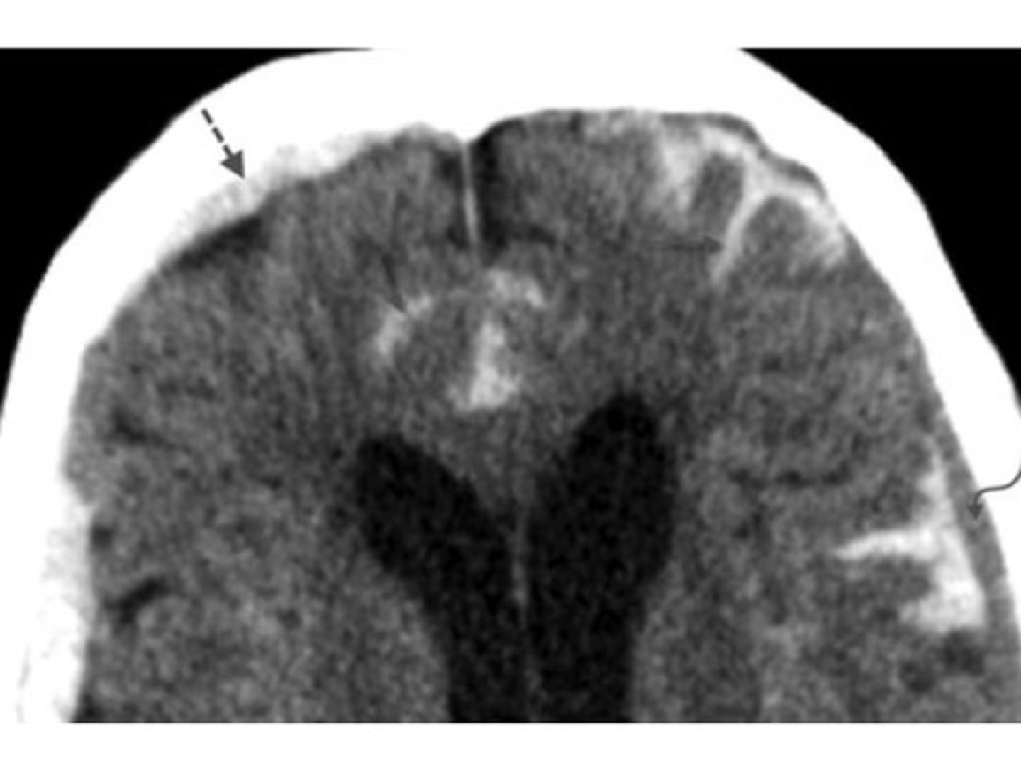<p>venous bleeding between the dura and arachnoid</p><p>*due to rupture of bridging veins</p>