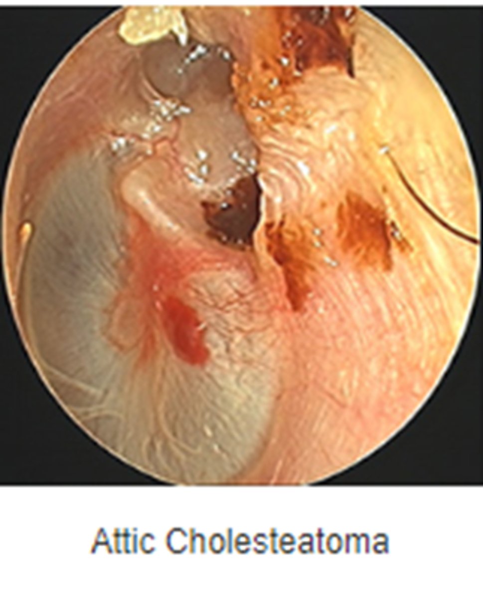 <p>Retraction pocket with accumulation of squamous debris<br><br>White mass behind a perforated TM</p>