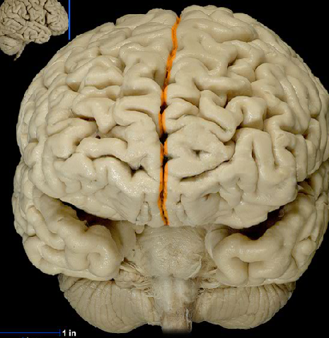 <p>Splits the hemispheres, runs front to back</p>