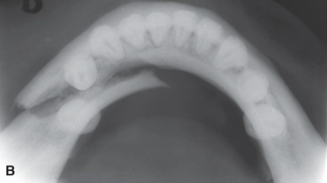 <p>fracture in mandibular body</p><ul><li><p>if you see one fracture, be on a close lookout for a second mandibular fracture</p></li><li><p>jaw fracture often comes in pair</p></li></ul><p></p>