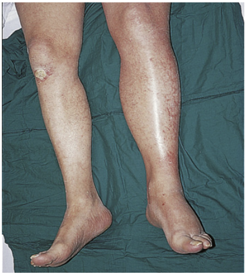 <p>Deep vein thrombosis (DVT)</p>