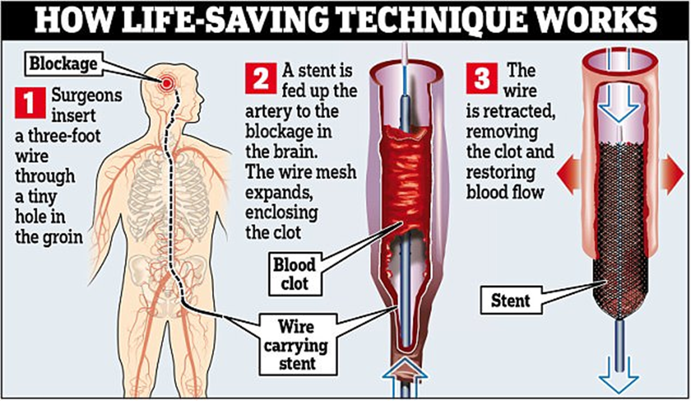<p><span style="color: #2dcbdf">• <strong>Catheter-based procedure</strong> to physically remove a blood clot</span><br>• Stent retriever is inserted through a blood vessel (e.g., femoral artery)<br>• Device expands to <strong>trap and extract the clot</strong></p>