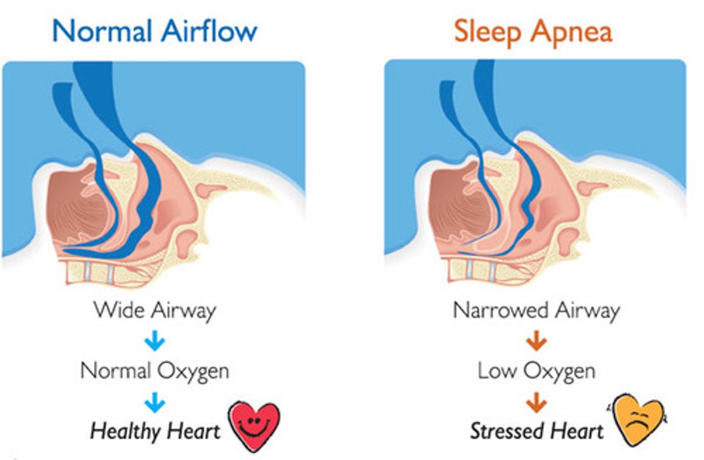 <p>(B) Sleep Apnea</p><p>Sleep Apnea is a sleep disorder that people are often unaware they have. People with sleep apnea stop breathing multiple times throughout the night resulting in the body not getting enough N3/slow wave sleep.</p>