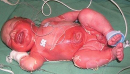 <p>Bacterial Skin Infections:</p><p>If an 8-month old patient presented w the following S/S, what may we suspect they have:</p><p>- fever &amp; irritability</p><p>- ill-defined, tender erythema with fine, sandpaper appearance on epidermis</p><p>- painful and superficial sloughing skin</p><p>- skin appears wrinkled</p>