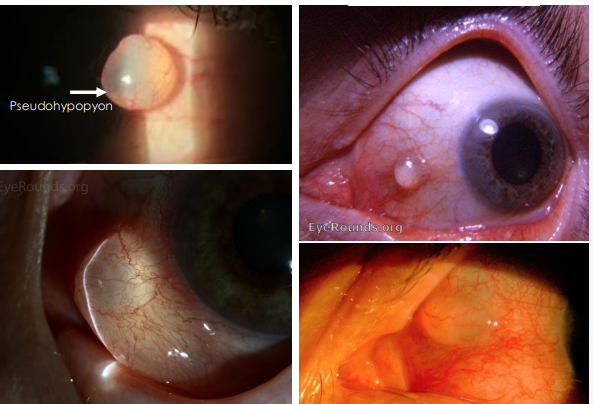 <ol><li><p>• Smooth, <strong><u>thin-walled cyst filled with clear serous fluid </u></strong></p></li><li><p>• Epithelial debris settles on the bottom forming “<strong><u>pseudohypopyon</u></strong>”</p></li></ol><p></p>