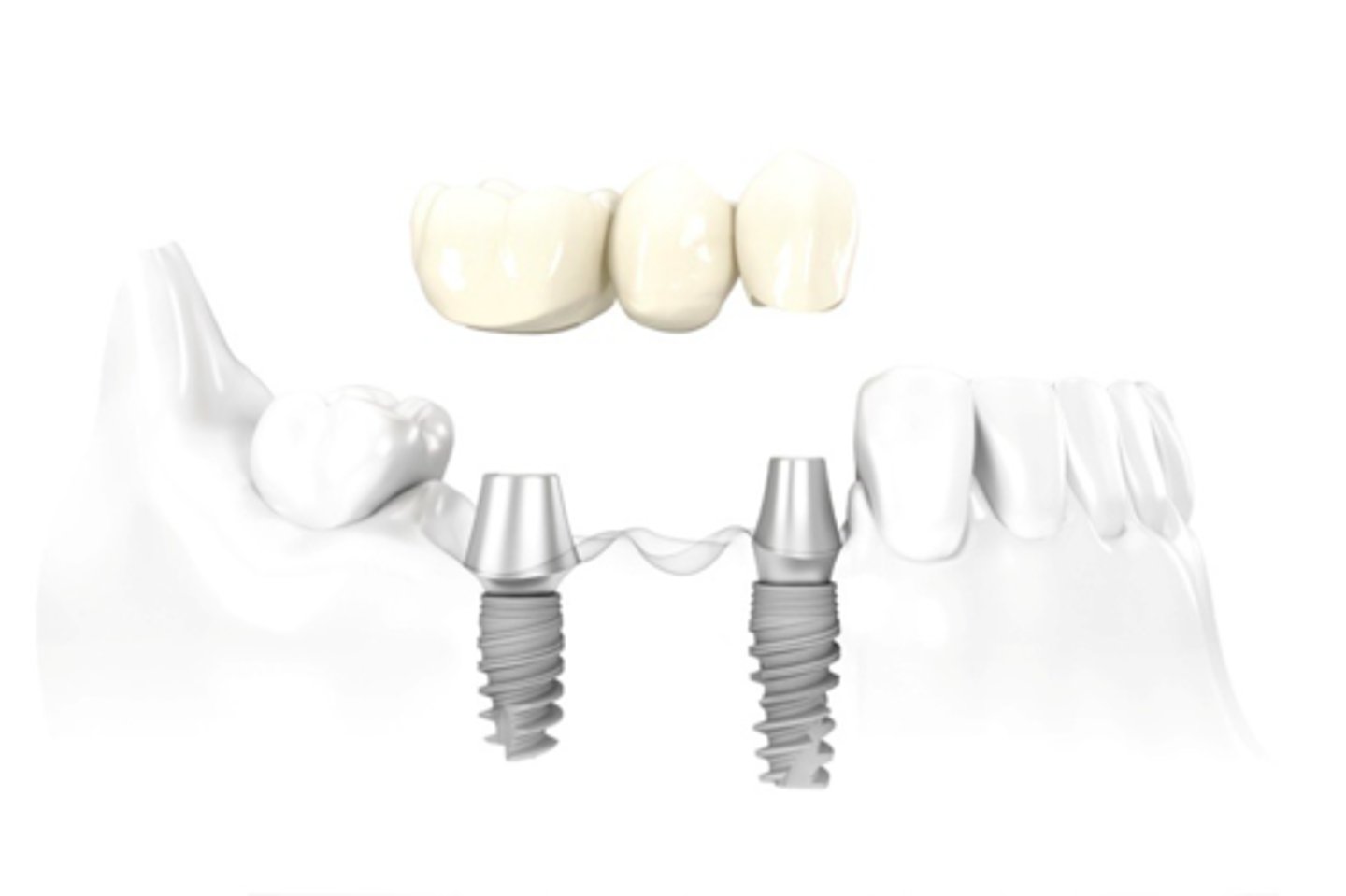 <p>ID the type of implant fixed partial denture:</p>