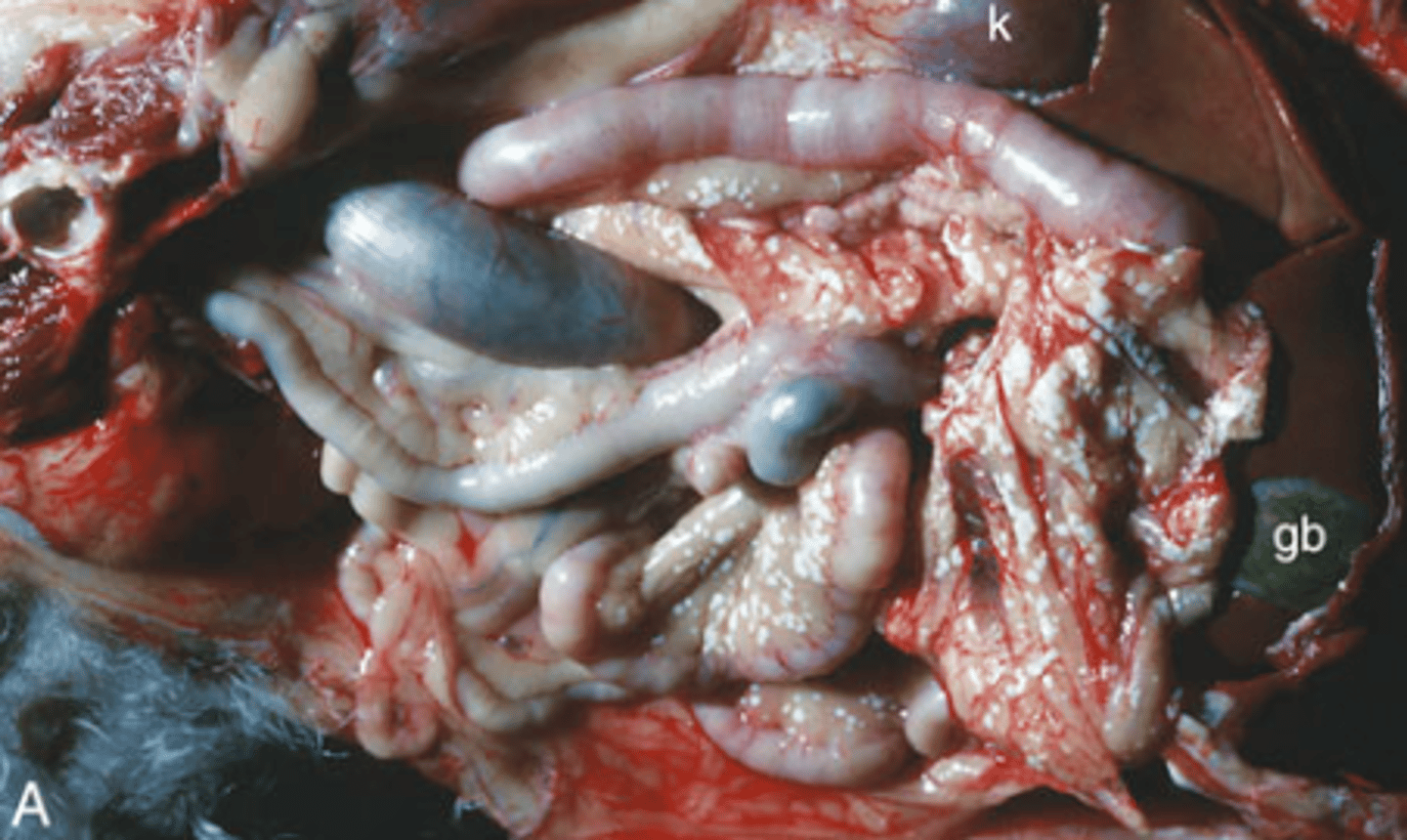 <p>This is an image of Fat Necrosis. What type of Fat Necrosis is seen? What causes this kind of fat necrosis?</p>