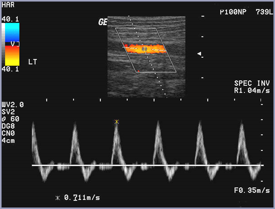 triphasic, no spectral broadening = good