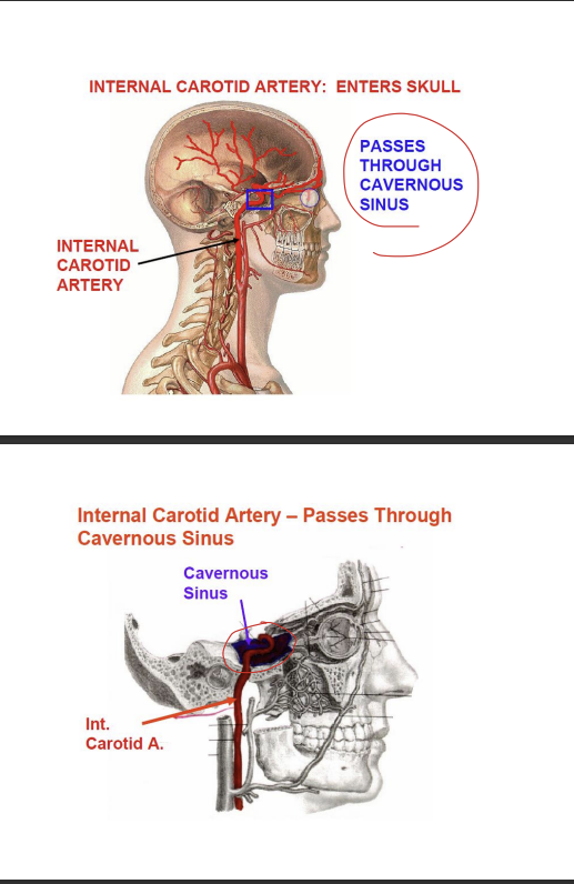 <p>cavernous sinus - found on the lateral aspects of the sella turcica </p><p>into skull through carotid canal </p>