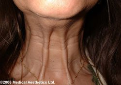 <p>Cords of the neck</p>
