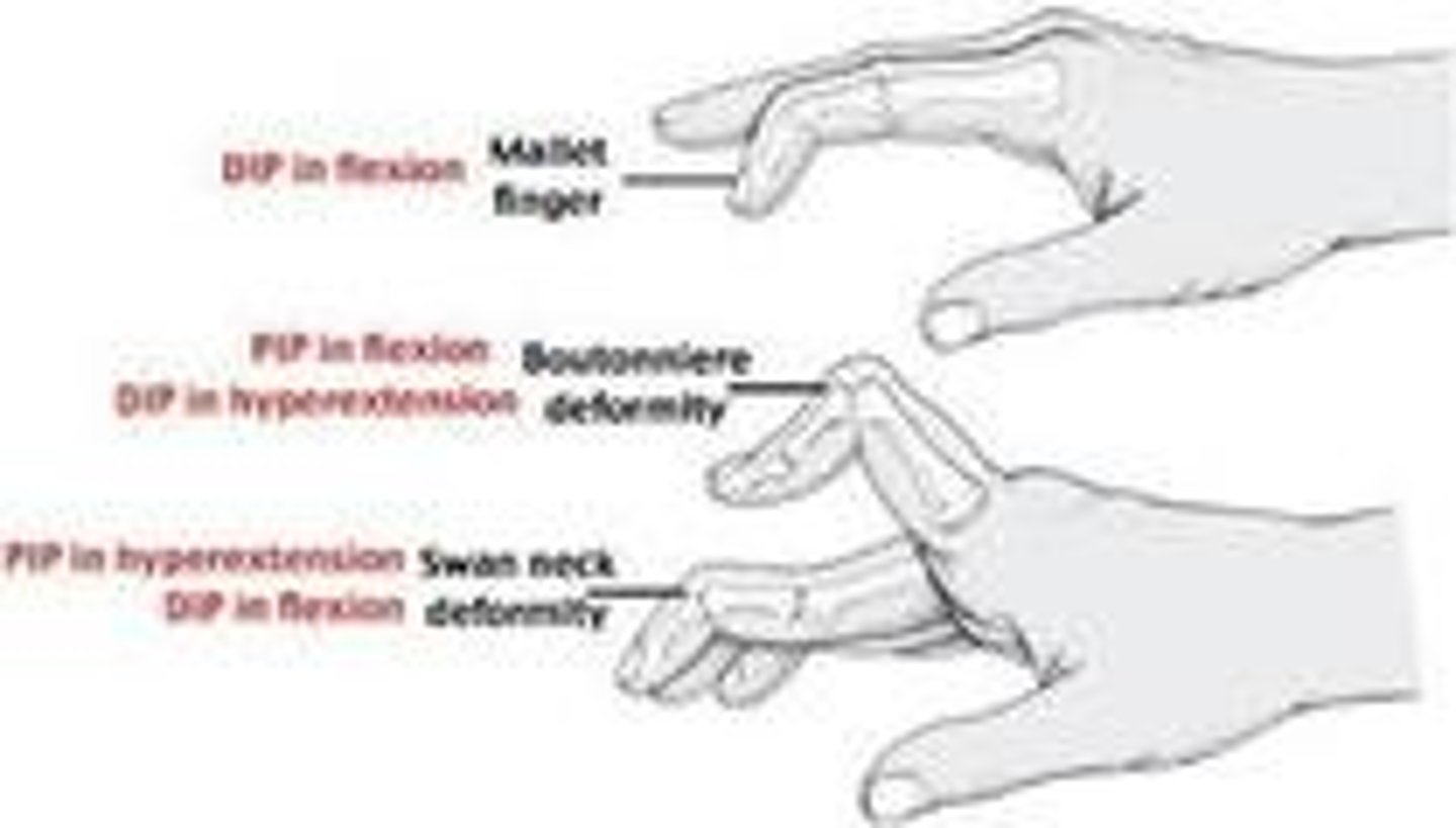 <p>Chronic tendinosis of the wrist flexors and pronators that attach to the medial epicondyle.</p>
