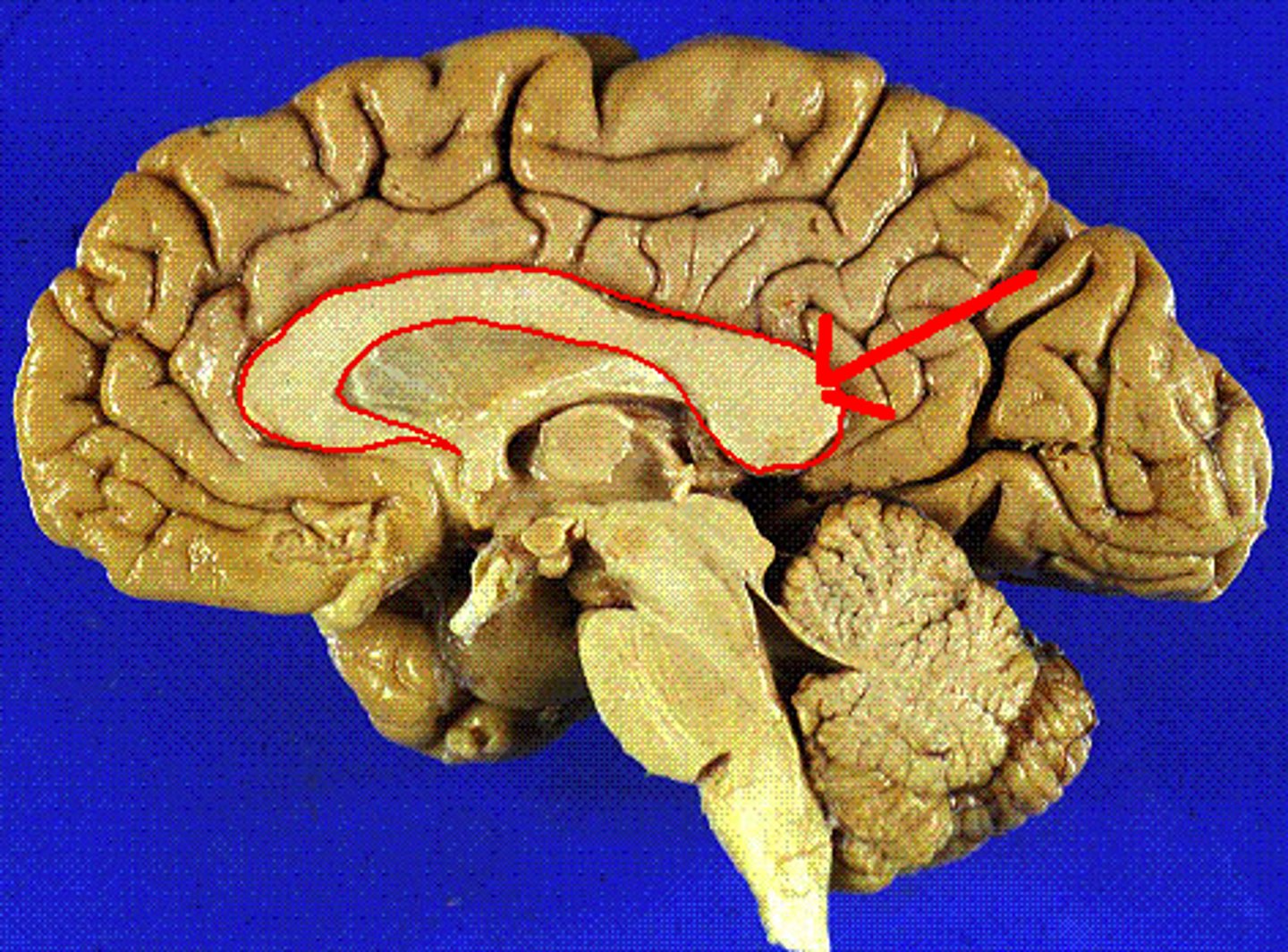 <p>The large bundle of axons (white matter) that connects the brain's two hemispheres, responsible for relaying information between the two sides.</p>