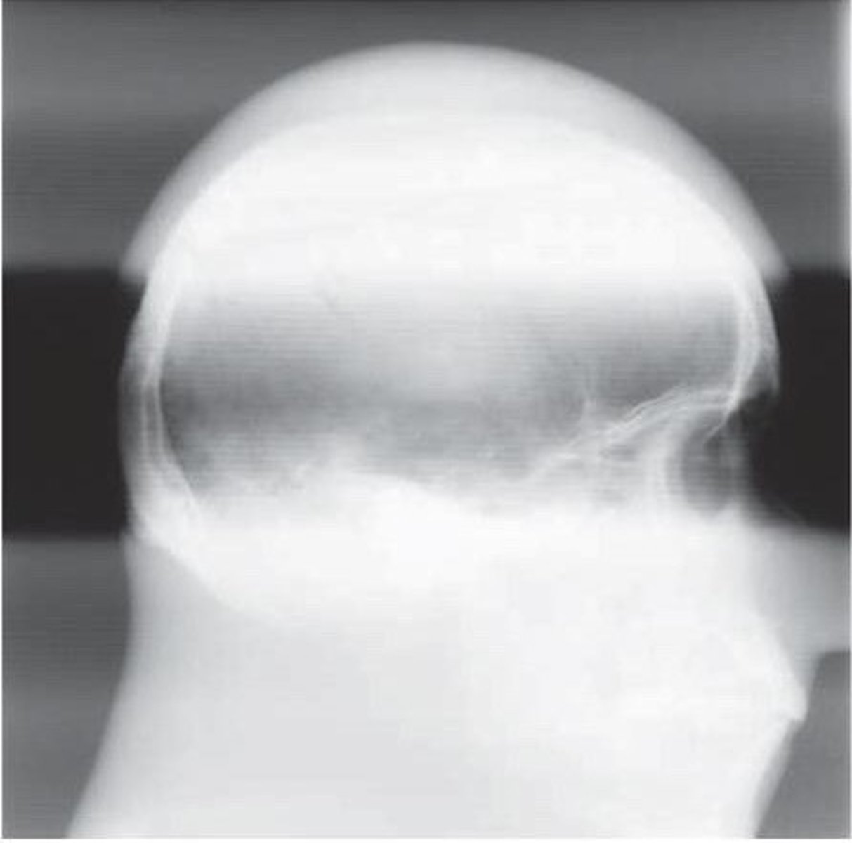 <p>severe grid cutoff on both sides of the image - usually happens w/ focused grids</p>