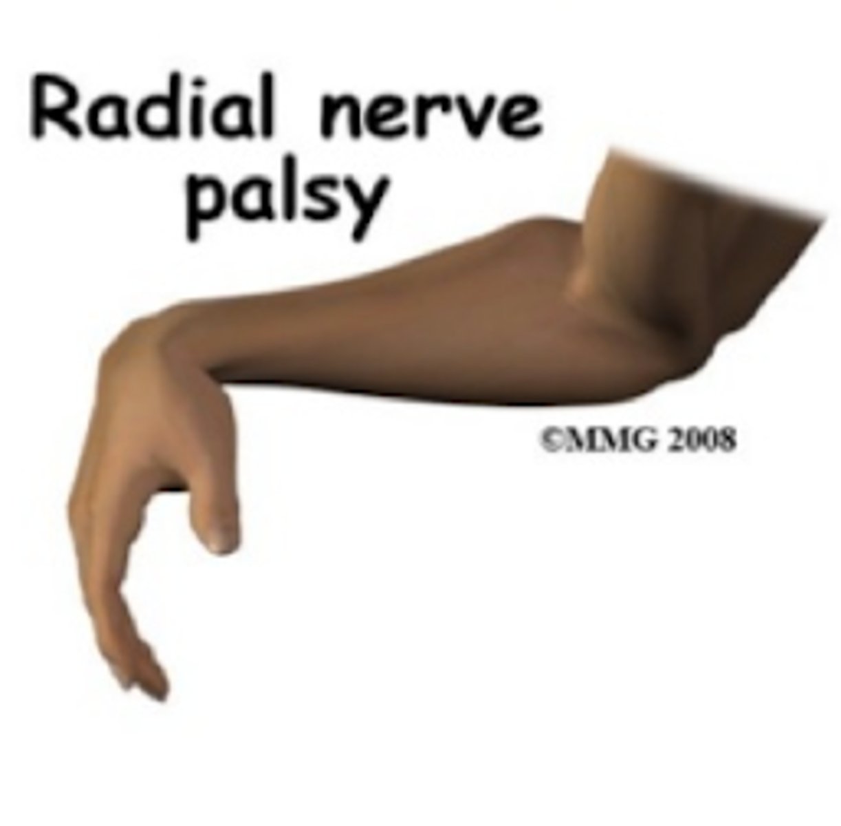 <p>radial (Saturday night/Crutch palsy)</p>