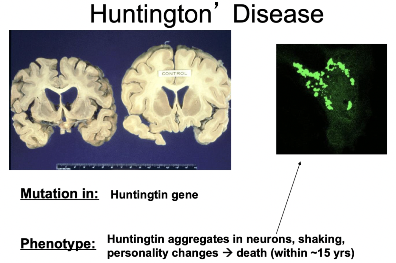 * mutation in Huntingtin gene
* phenotype: huntingtin collects in neurons; shaking; personality changes → death within approx. 15 years
* **example of autosomal dominant inheritance**