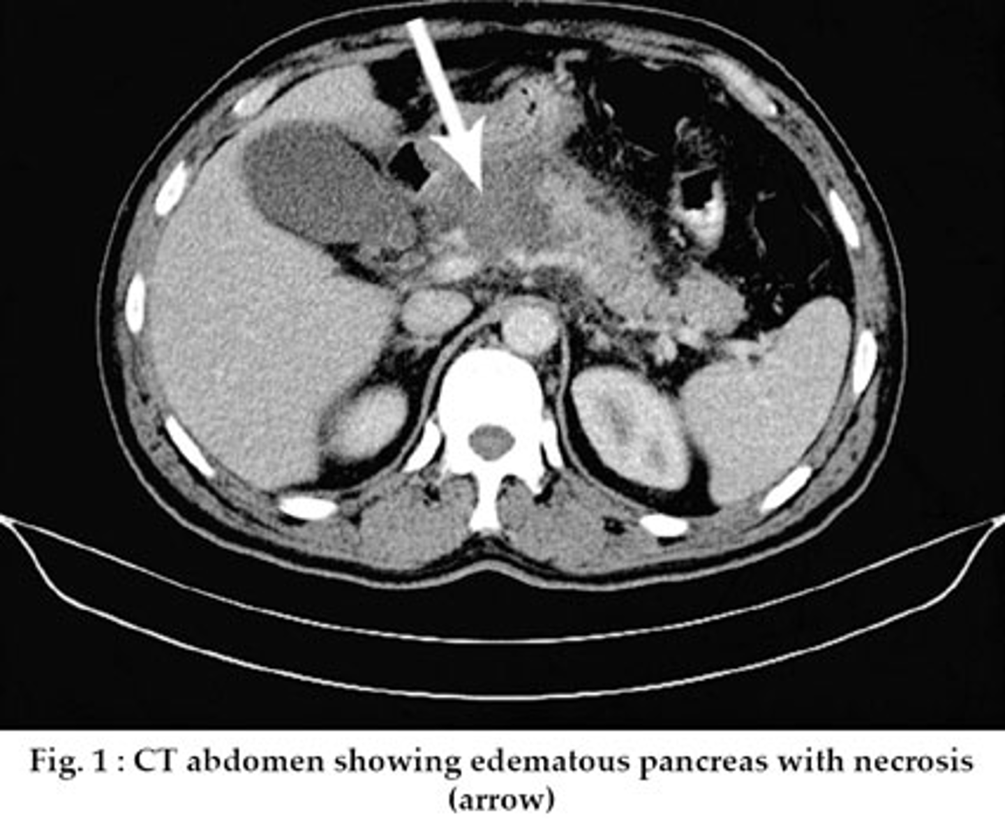 <p>A CT scan will show diffuse/focal nonviable pancreatic tissue +/- peripancreatic fat necrosis. >30% of the pancreas should be affected.</p><p>Infected necrosis just means that the necrotic tissue is positive for microorganisms.</p>