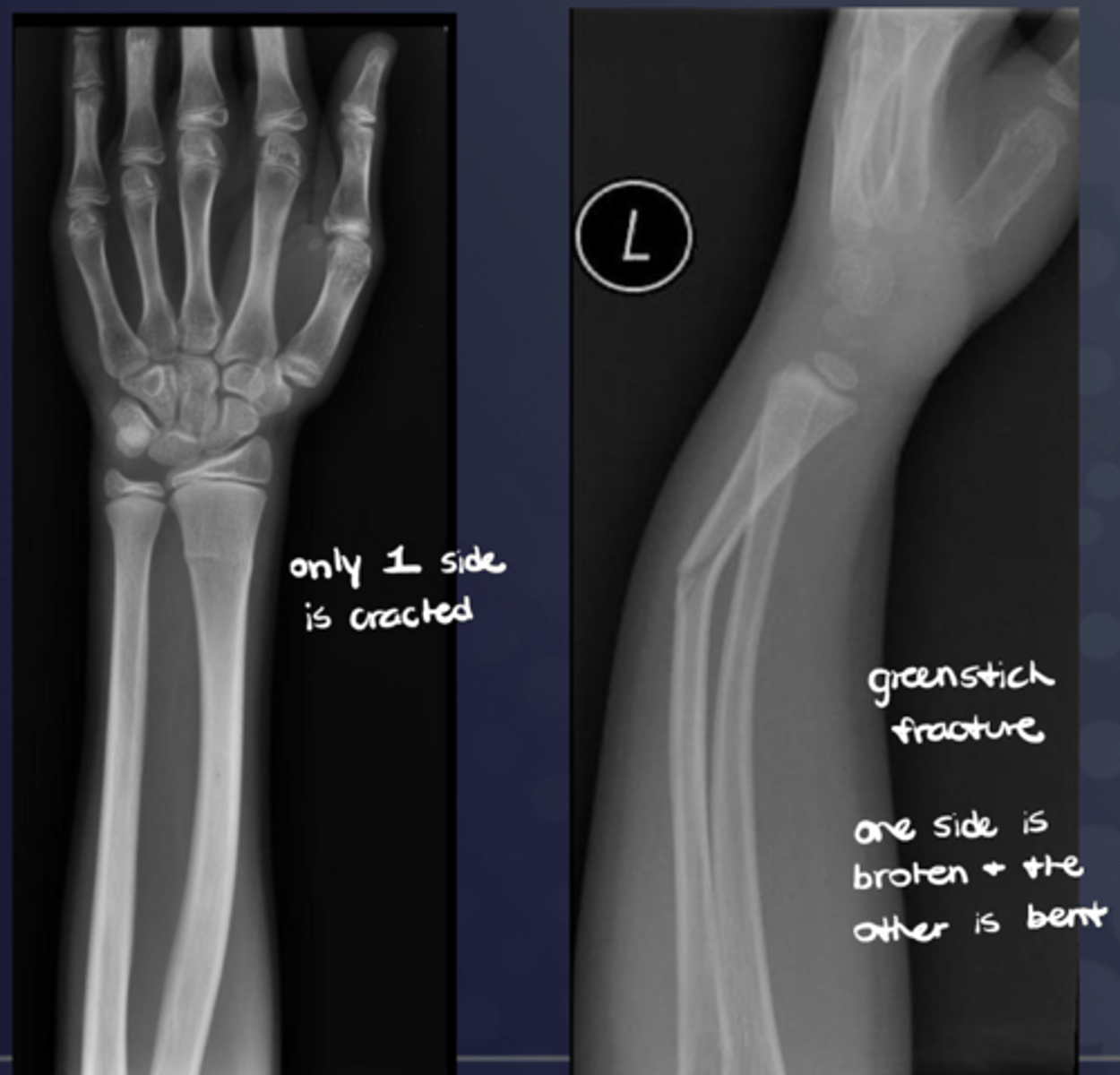 <p>Fracture "hinges" on an unbroken cortex (e.g., "greenstick fracture" in immature bone)</p>