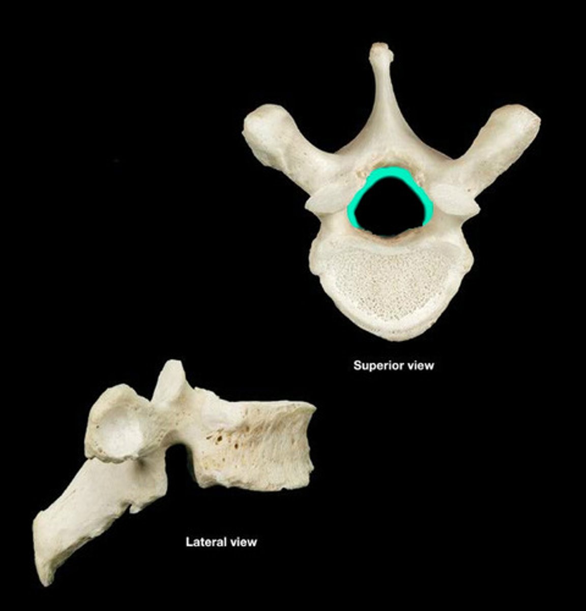 <p>opening in vertebrae through which spinal cord passes</p>