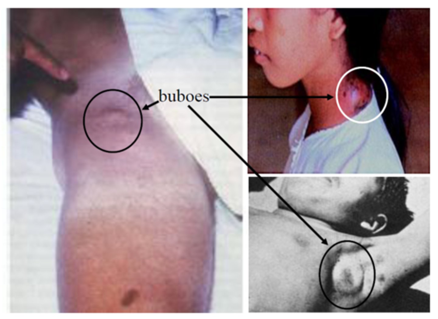 <p>A swollen, inflamed lymph node in the armpit or groin</p>