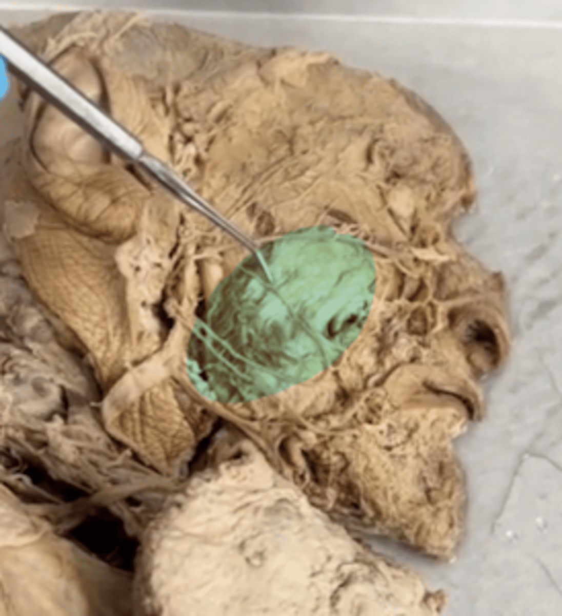 <p>Name the muscle.</p>