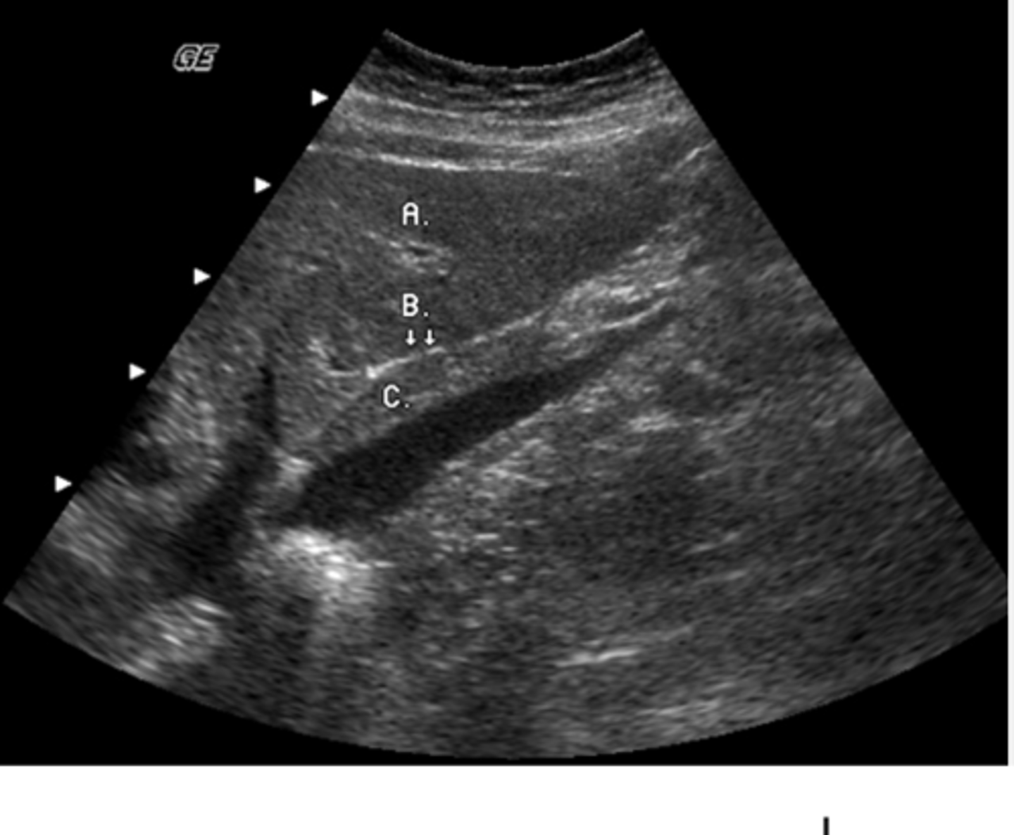 <p>What lobe of the liver does the letter A represent?</p><p>a. left lobe</p><p>b. caudate lobe</p><p>c. posterior right lobe</p><p>d. anterior right lobe</p><p>e. quadrate lobe</p>
