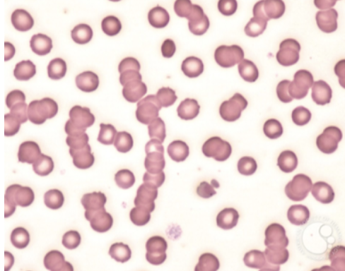 <p>What type of smear cell and what conditions is it seen in</p>