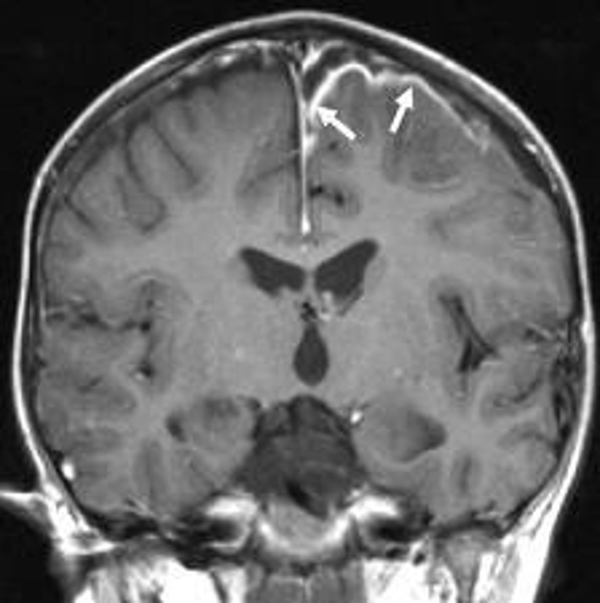 <p>Define Condition:</p><p>A collection of pus between the dura and the arachnoid membranes</p><p>-Complication of sinus infection, but can also be due to ear infection, cranial trauma or surgery, and bacteremia</p><p>-May produce mass effect, arachnoid and subarachnoid areas are spared</p><p>-Dx: IICP, Herniation, LP = HIGH PROTEIN, PMNs</p>