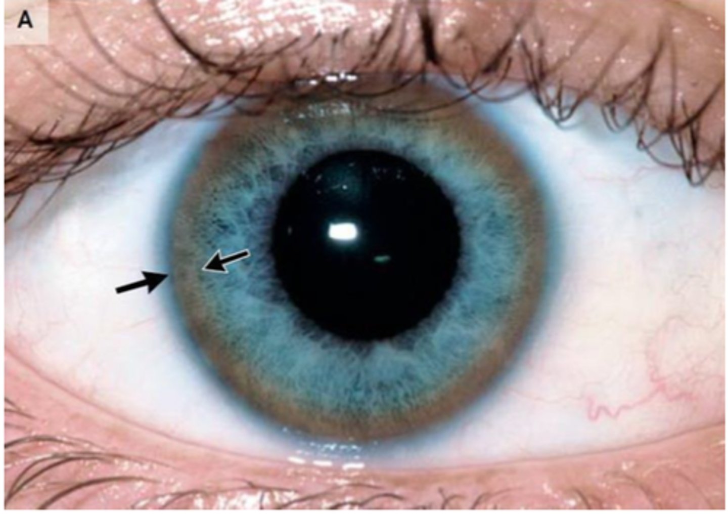 <p>Define Condition:</p><p>Hepatolenticular degeneration due to genetic defect, “ar” on Chromosome 13 causing abnormal metabolism and deposition of copper</p><p>-Hx: +FHx, Young Onset</p><p>-Sx/PE: Unexplained dyskinesia/tremor (typically produces dystonic tremors); deposition of copper in brain, liver (cirrhosis) &amp; eye (kaiser-flesher ring)</p><p>-Dx: Labs for 24 hr copper UA (high) and serum ceruloplasmin (low) + Liver Biopsy</p><p>-Tx: Chelation Therapy</p>