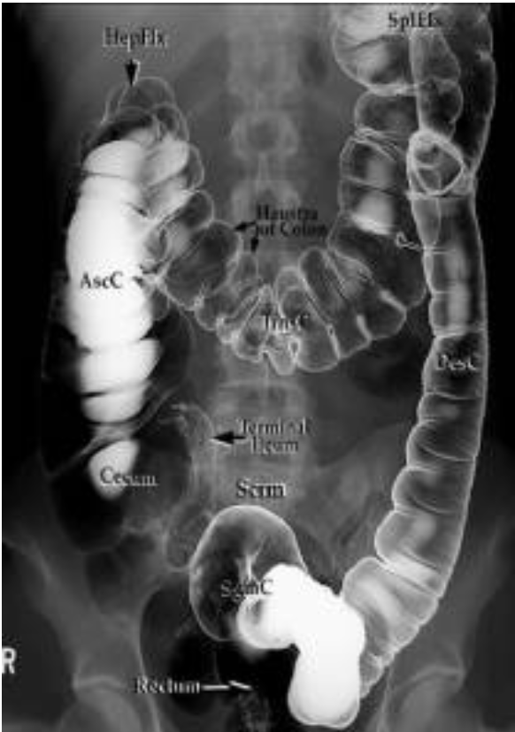 <p>What imaging to assess for <strong>obstructions in large bowel?</strong></p>