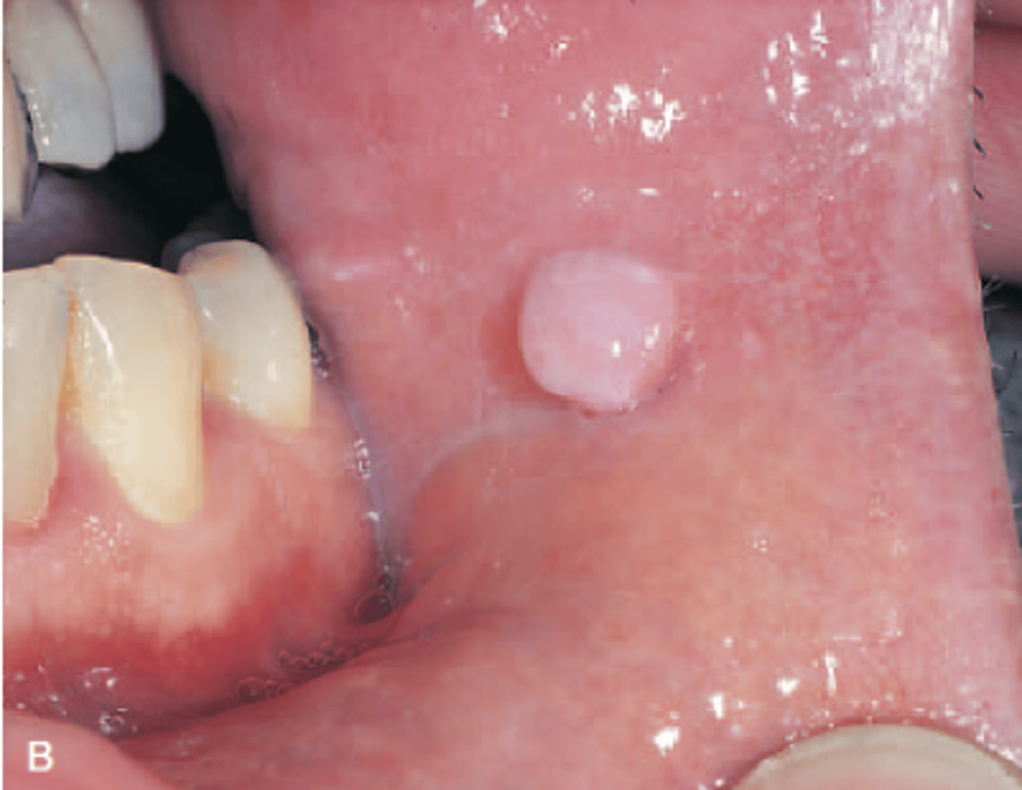 <p>AKA irritation fibroma; MOST COMMON GROWTH!!!</p><p>• well-defined, small, painless nodule</p><p>• can be ulcerated</p><p>• pink or whitish</p><p>• associated with trauma </p>